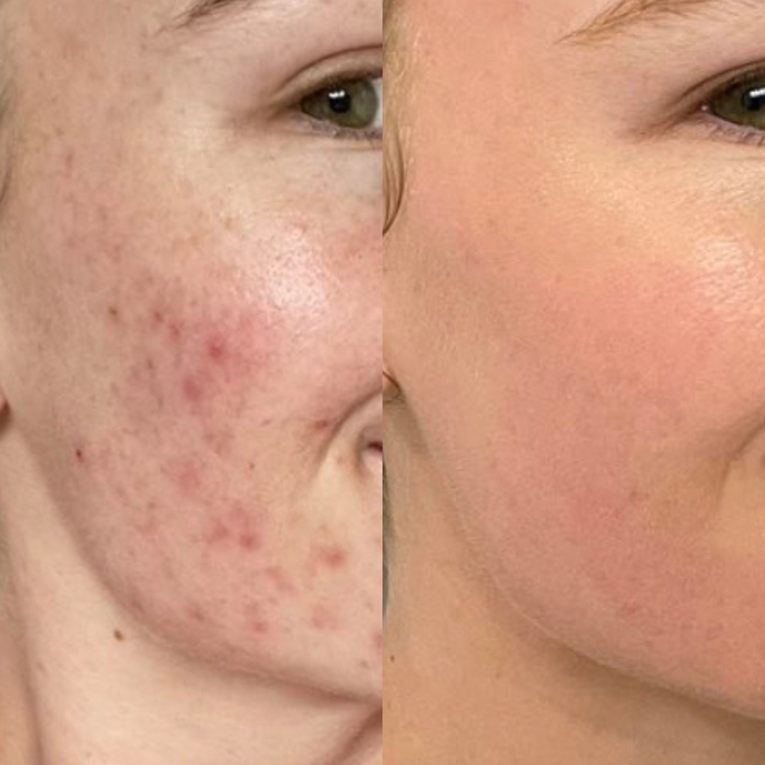 Month Routine - Tratamiento anti-acne + manchas