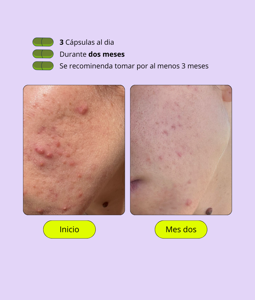 A CONTROL - ACNÉ HORMONAL & RESISTENCIA A LA INSULINA