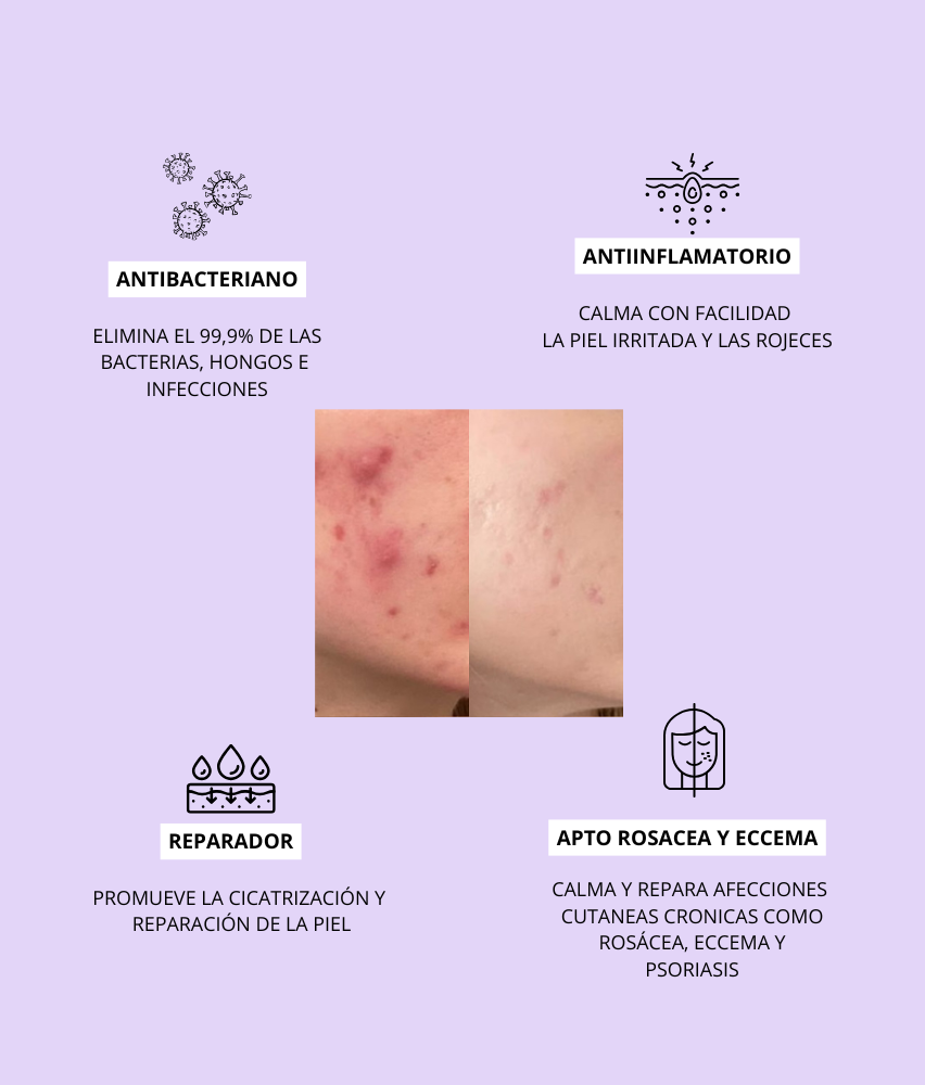 MIRACLE H - ÁCIDO HIPOCLOROSO - TÓNICO ANTIBACTERIANO Y ANTIINFLAMATORIO