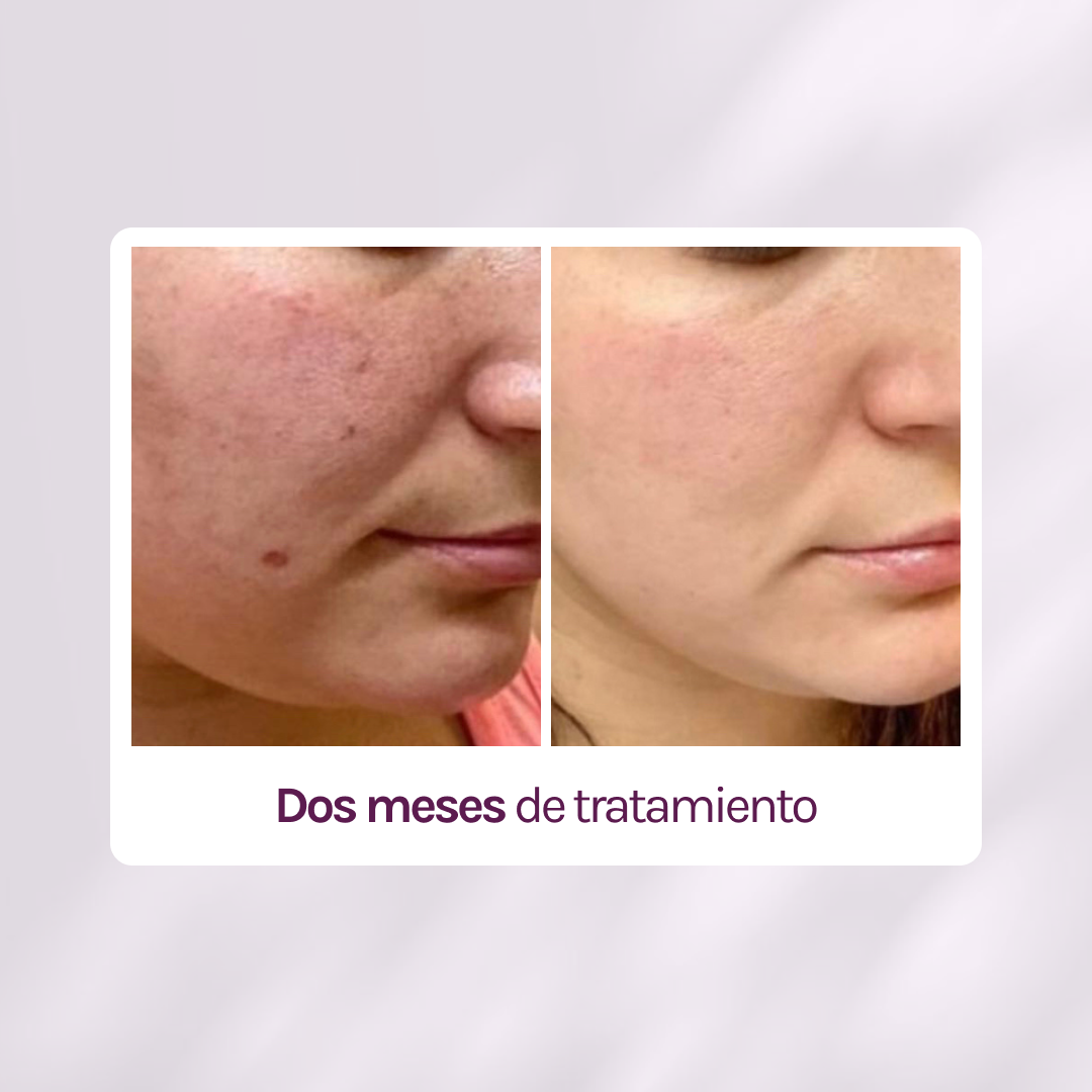 KIT TRATAMIENTO - MANCHAS + GRANITOS + IMPERFECCIONES