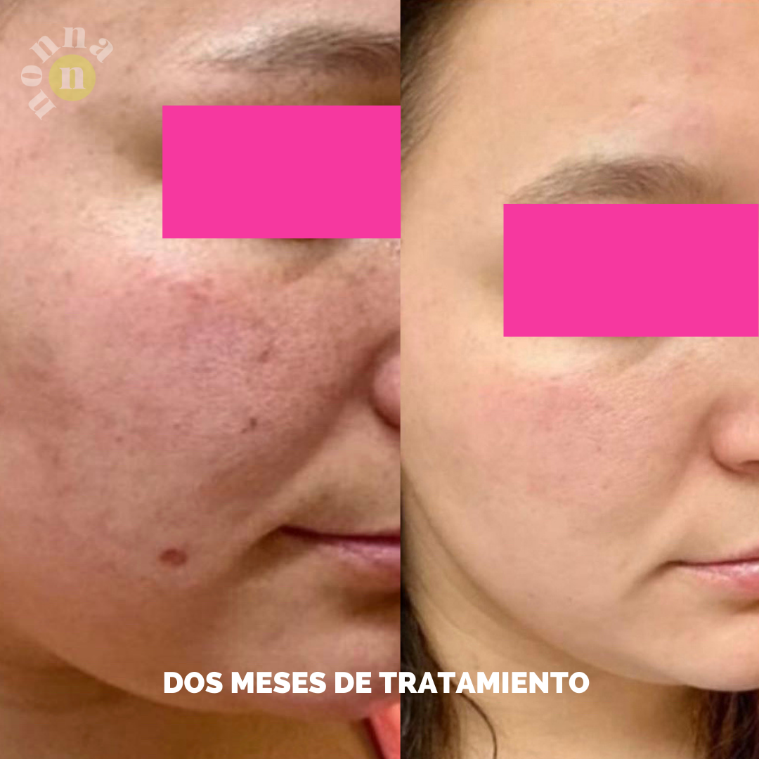 RUTINA FULL ACNÉ - ANTIBACTERIANA + GRANITOS + MARCAS + POROS