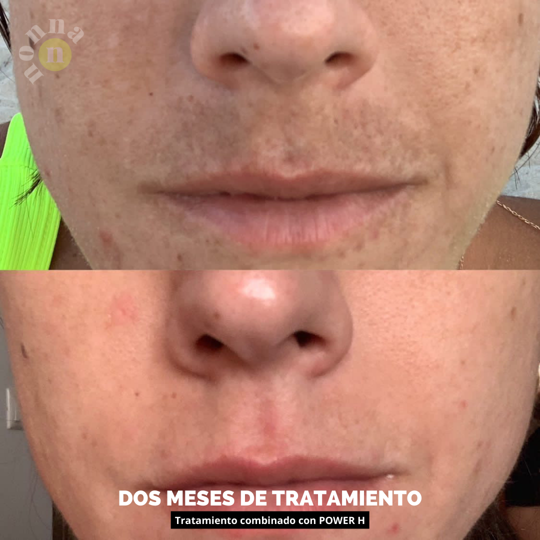 KIT TRATAMIENTO - MANCHAS + GRANITOS + IMPERFECCIONES