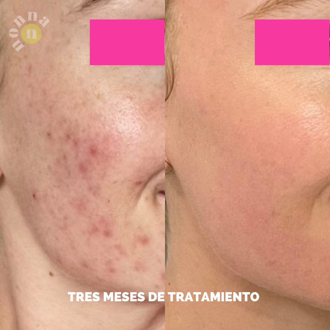 RUTINA AM&PM - GRANITOS + MARCAS + POROS + MANCHAS + ARRUGAS