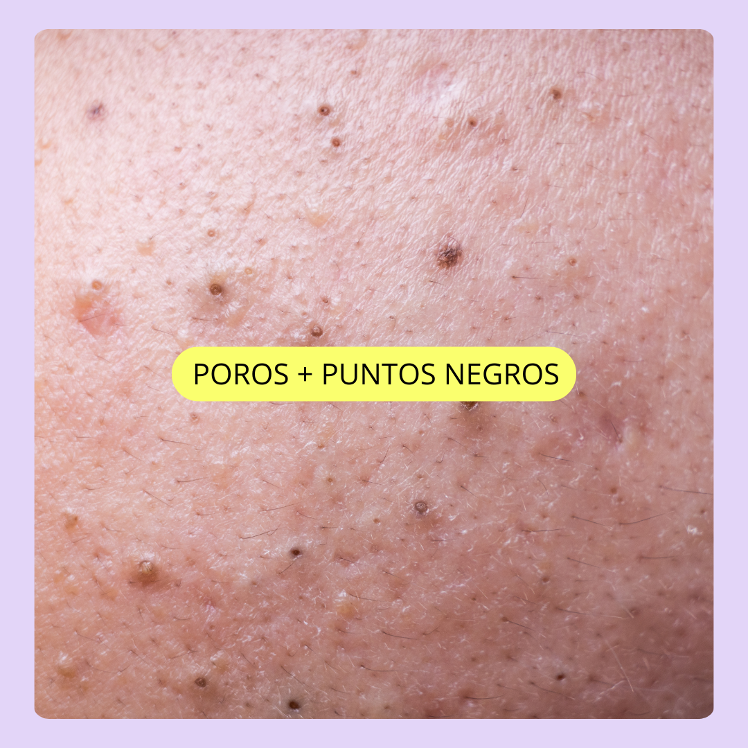 POROS + PUNTOS NEGROS