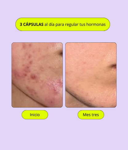 A CONTROL - ACNÉ HORMONAL &amp; RESISTENCIA A LA INSULINA