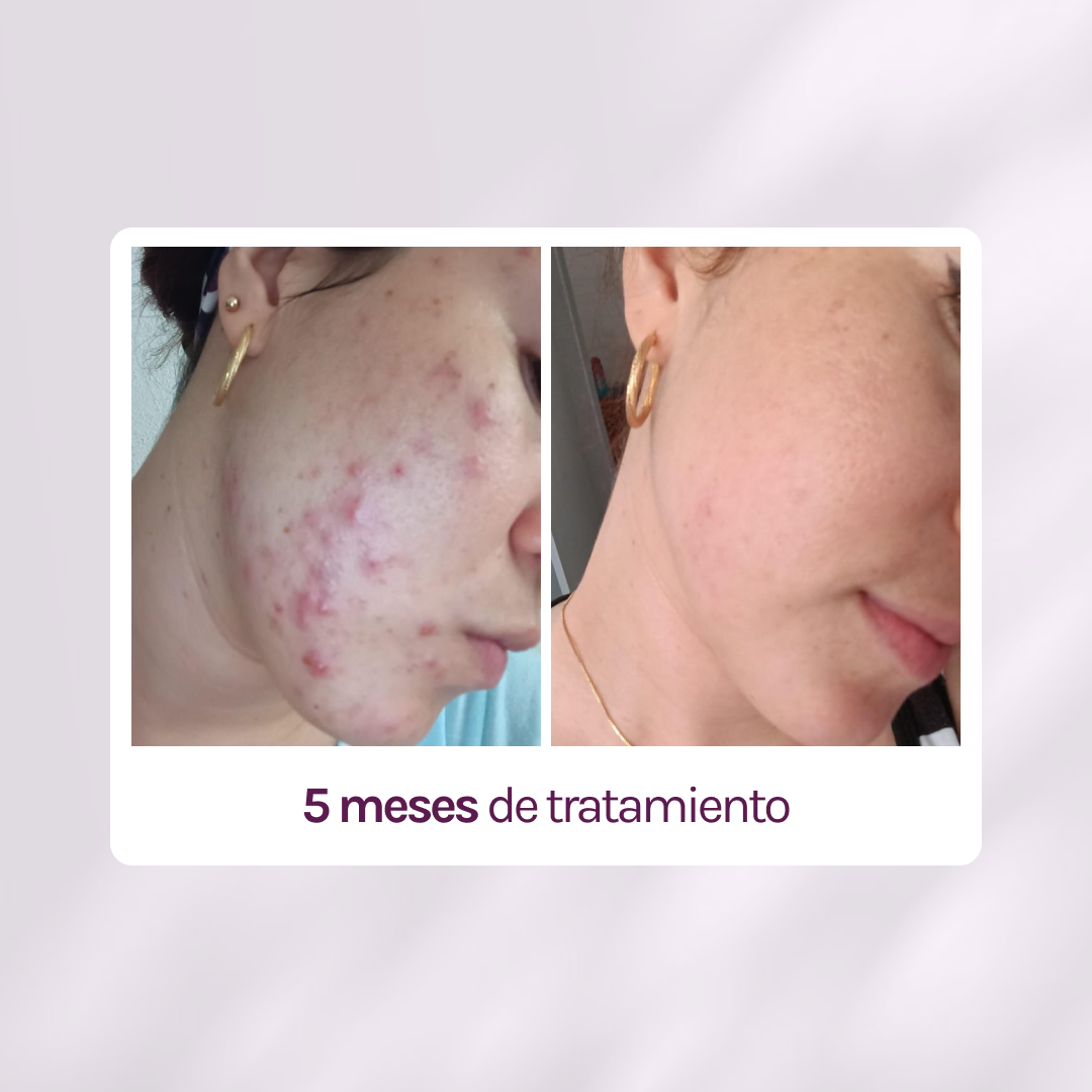 KIT TRATAMIENTO - MANCHAS + GRANITOS + IMPERFECCIONES